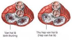 Tư vấn: Liệu pháp hiệu quả cho bệnh hẹp van hai lá